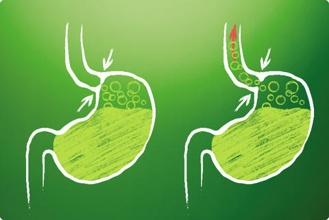 Illustration von zwei Mägen und Speiseröhren - Darstellung wie die Speiseröhre funktioniert - mit und ohne Reflux